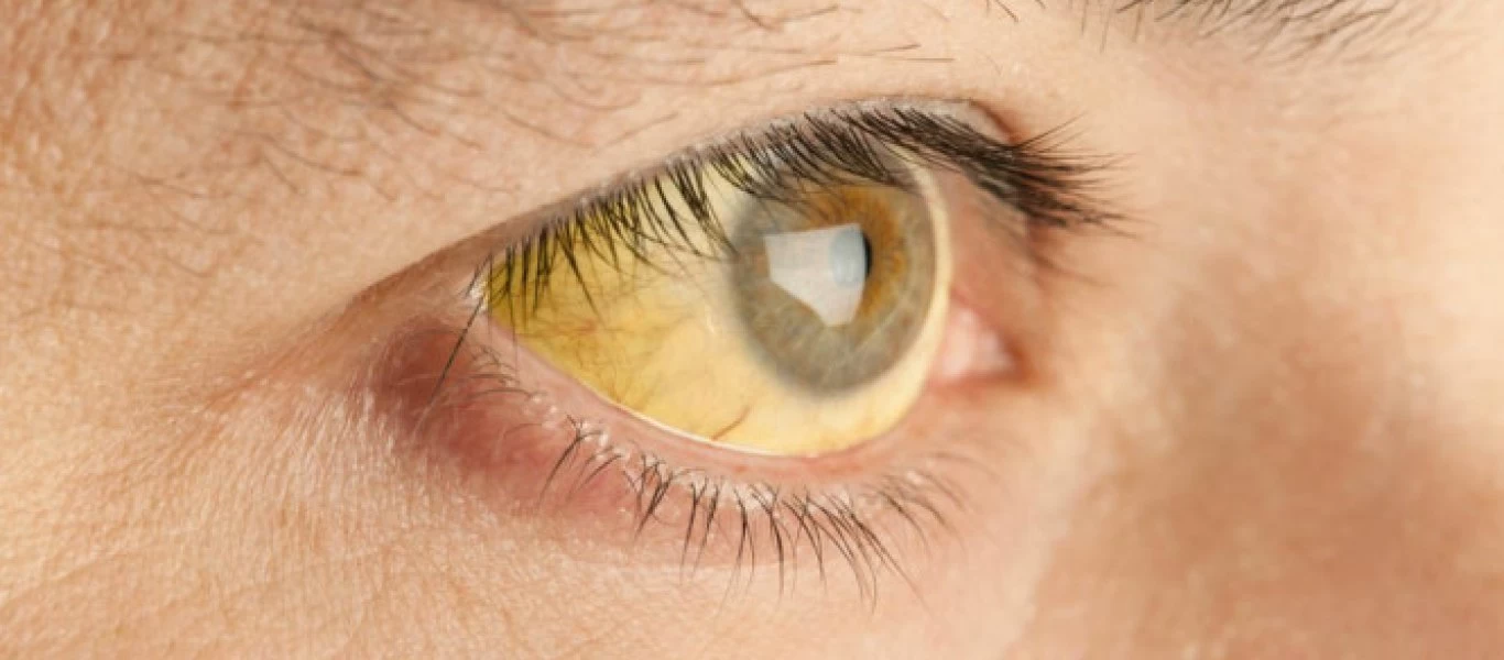 Αυτές είναι οι 9+1 πιθανές αιτίες για τα κίτρινα μάτια